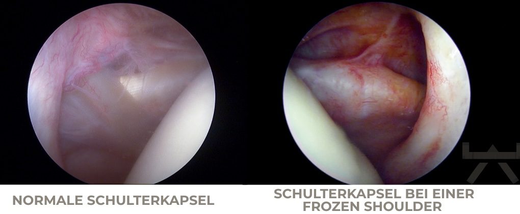 Gezielte Schulterübung für Menschen aus Ennigerloh und Beckum zur Lösung von Bewegungseinschränkungen bei Frozen Shoulder.