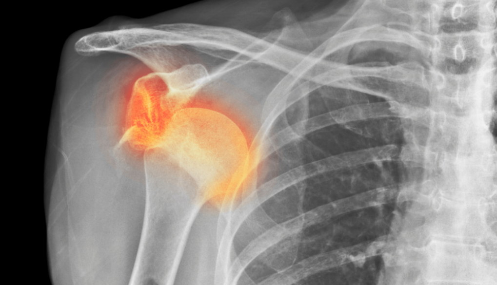 Physiotherapeut erklärt den Ablauf einer Schulterluxation und zeigt erste sichere Bewegungsansätze in der NEXCORE Physiotherapie Ennigerloh.