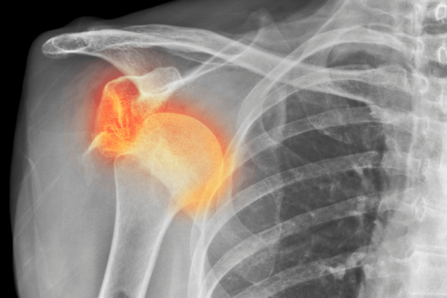 Geführte Rehaübungen zur Stabilisierung der Schulter nach Luxation.