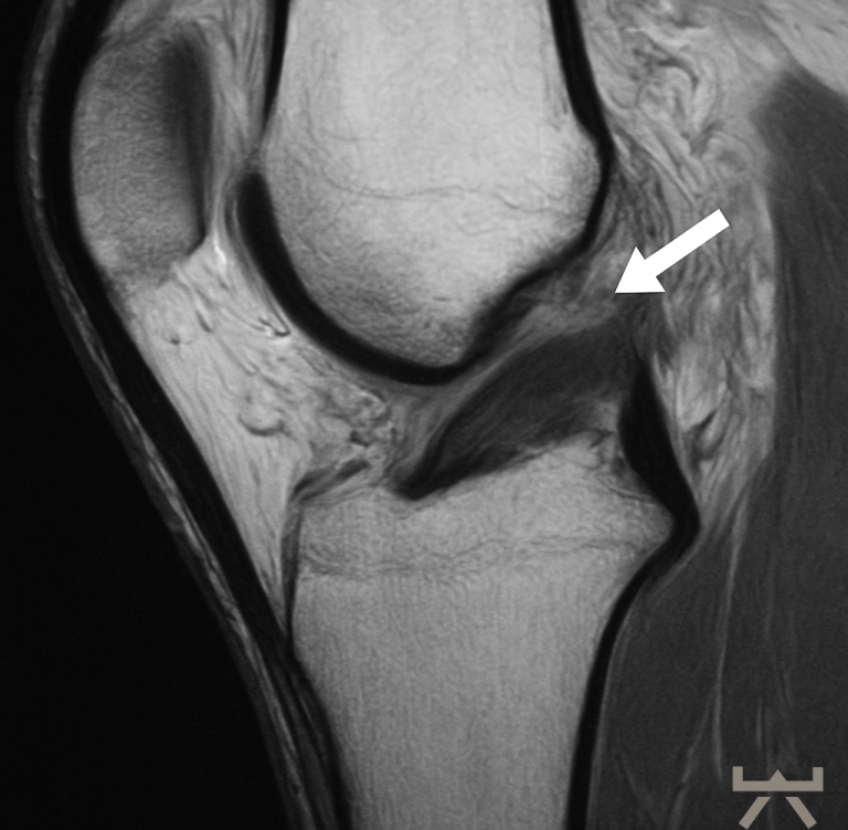 Gezielte Stabilisationsübung für das Knie nach Kreuzbandverletzung, geeignet für Menschen aus Oelde und Beckum.