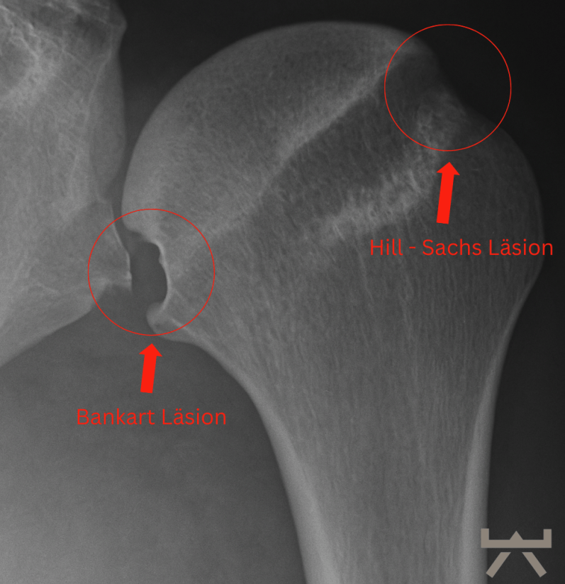 Physiotherapeutische Mobilisationsübung zur Wiederherstellung der Beweglichkeit der Schulter für Personen aus Neubeckum und Warendorf.