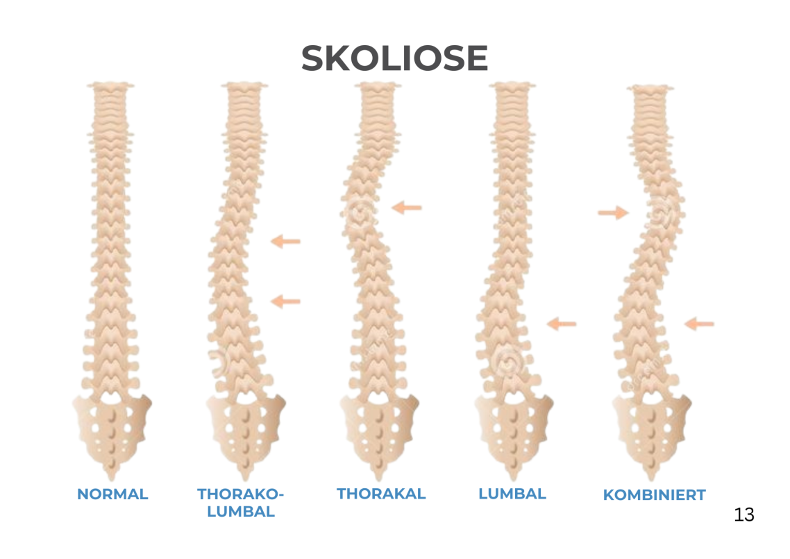 Skoliose Fitnessstudio Ennigerloh Skoliose Fitnessstudio Ennigerloh